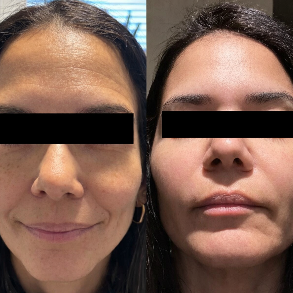 Rejuvenescimento facial com naturalidade. Comparativo com depois à esquerda e antes à direita.